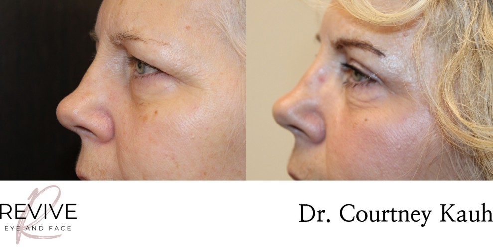 Upper Eyelid Blepharoplasty