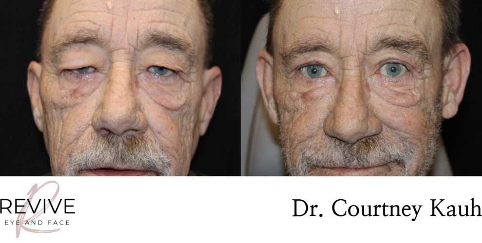 Upper Eyelid Blepharoplasty