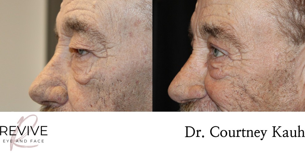Upper Eyelid Blepharoplasty