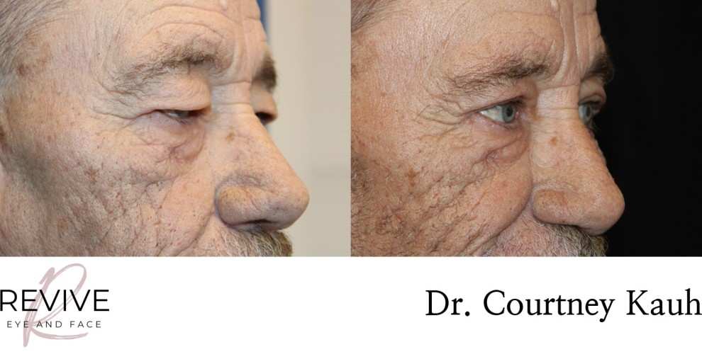 Upper Eyelid Blepharoplasty