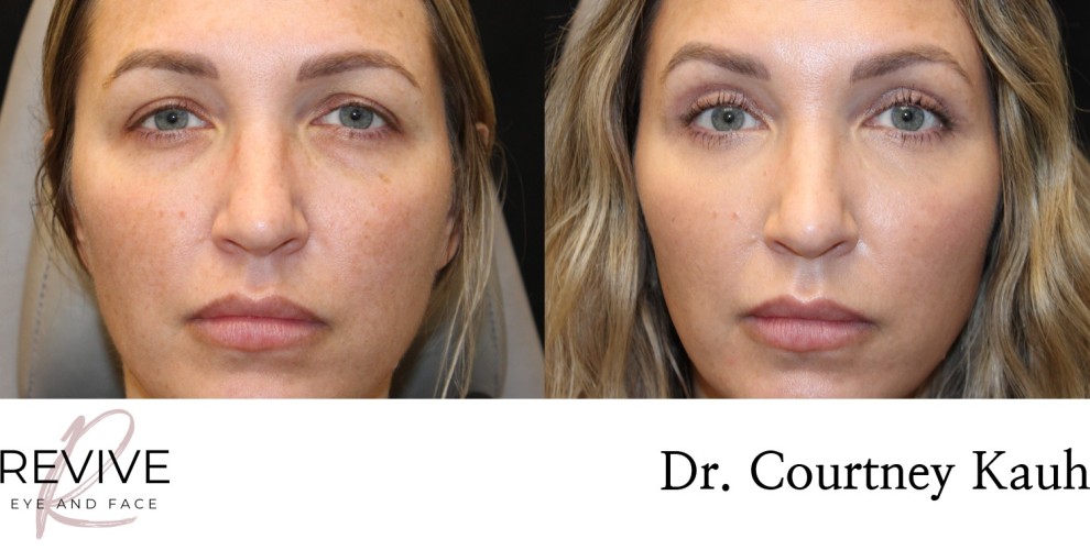 Upper Eyelid Blepharoplasty