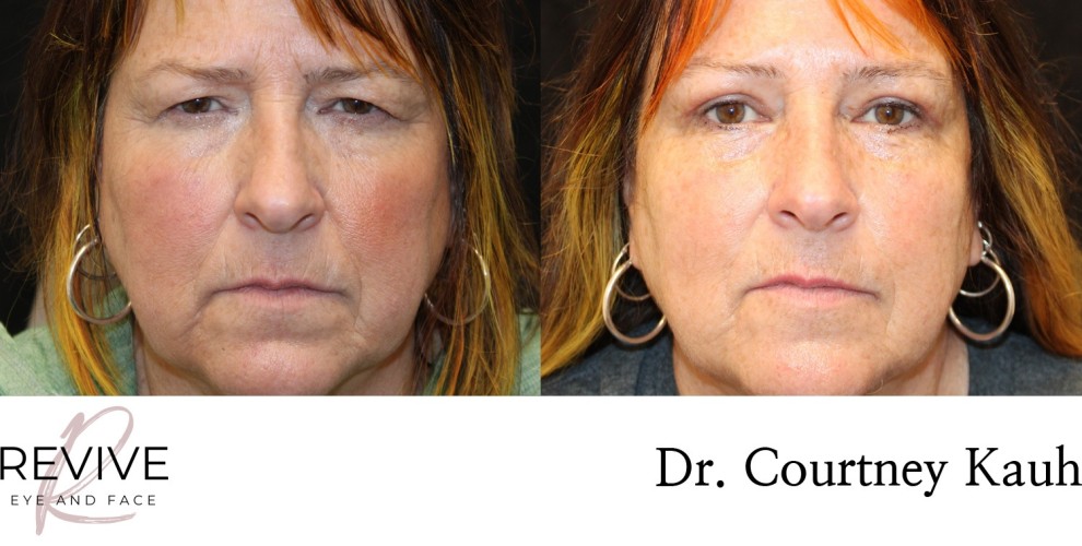 Upper Eyelid Blepharoplasty