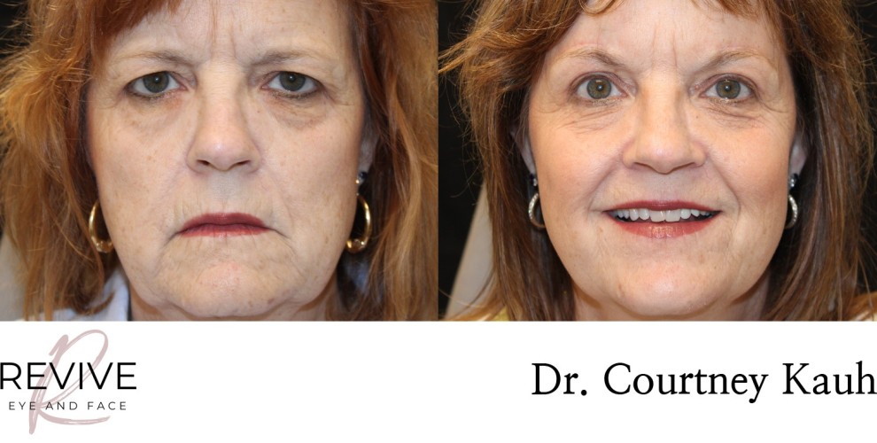Upper Eyelid Blepharoplasty