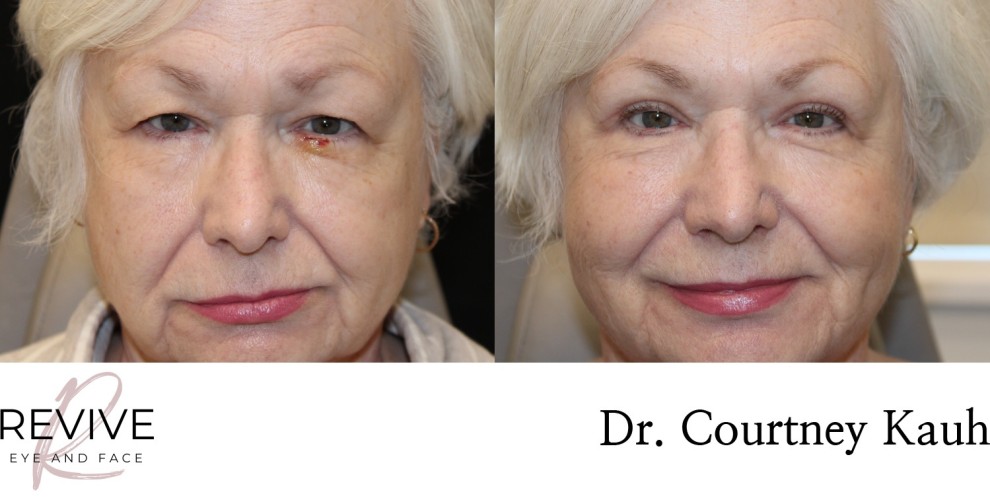Upper Eyelid Blepharoplasty