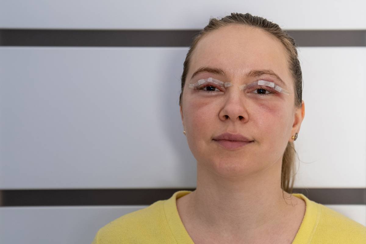 The image shows a woman who has recently undergone blepharoplasty and shows what one can expect of the recovery process from blepharoplasty.