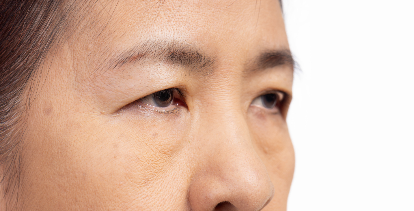 The image shows a close up of a senior Asian woman to explain how to prepare for an Asian blepharoplasty.