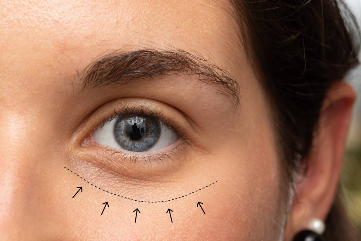 concept for most common eyelid surgeries