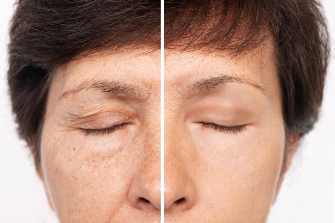 Featured image for How Long Do Eyelid Surgery Results Last